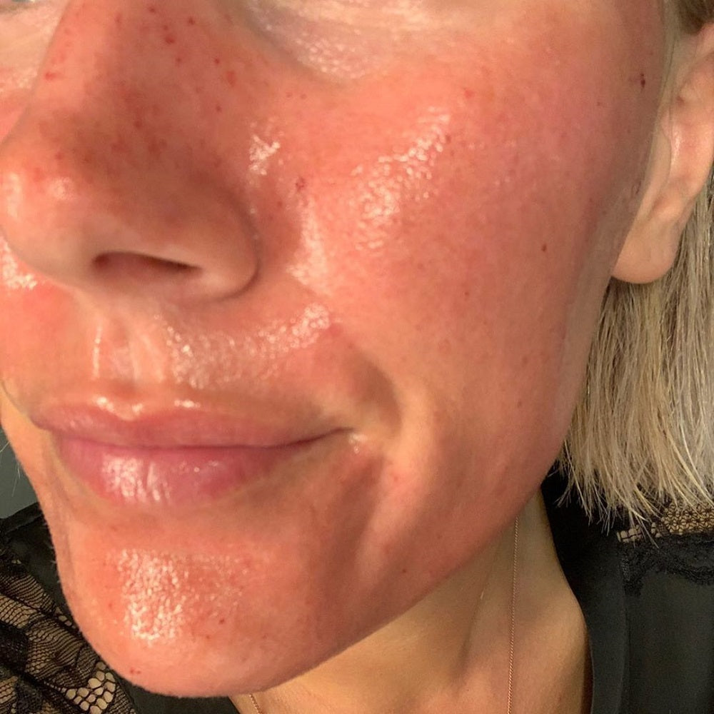 Resultat efter microneedling